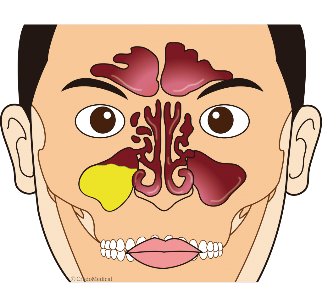 副鼻腔炎(ちくのう)の注意点、治療について。早期発見し完治させることが大切！ | 尾道市向島町の小坂耳鼻咽喉科クリニック